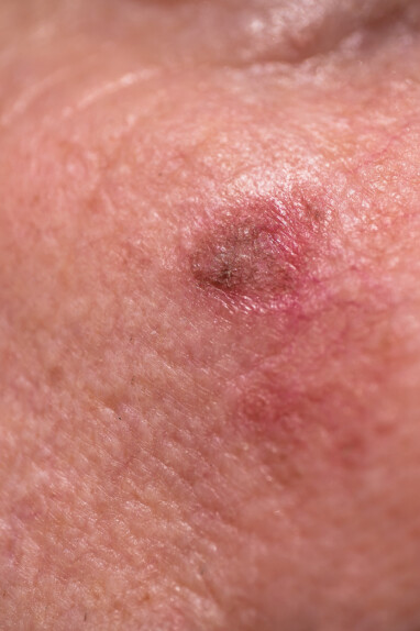SOLAR KERATOSE UNDER HØYRE ØYE: Denne solskaden er lett pigmentert. Kan effektivt behandles med for eksempel frysebehandling, såkalt kryobehandling. FOTO: NTB Scanpix / Shutterstock / Henk Vrieselaar SOLAR KERATOSE UNDER HØYRE ØYE: Denne solskaden er lett pigmentert. Kan effektivt behandles med for eksempel frysebehandling, såkalt kryobehandling. FOTO: NTB Scanpix / Shutterstock / Henk Vrieselaar